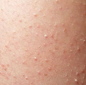 Itchy Bumps On Legs / Itchy Bumps on Skin like Mosquito Bites, Bug Bites, Spots ... : Having itchy red bumps on legs or any other parts of the body is a clear sign of having a serious health problem.