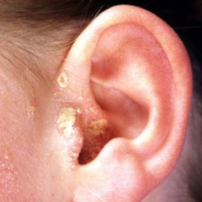 ear scabs scab canal ears lobe behind away go crusty hurts won dry piercing heal fold painful wont