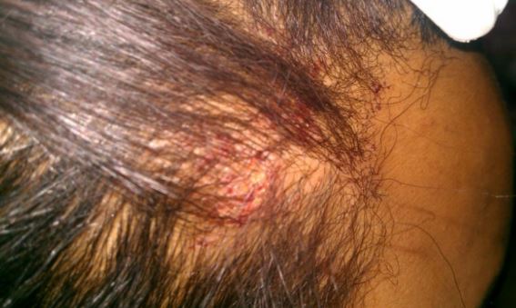 Scabs On Scalp Causes Treatment And Remedies Treat Cure Fast