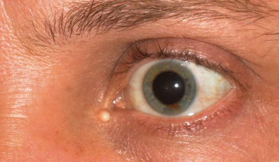 White Bump on Eyelid
