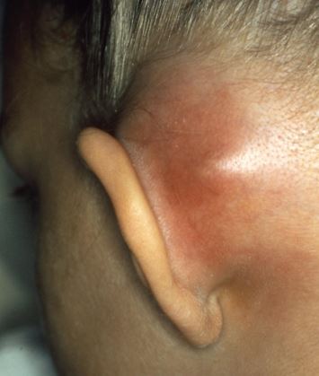 Mastoid bone infection bump - Image Source - Wikipedia