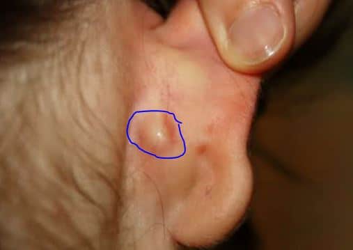 Soft lump behind ear