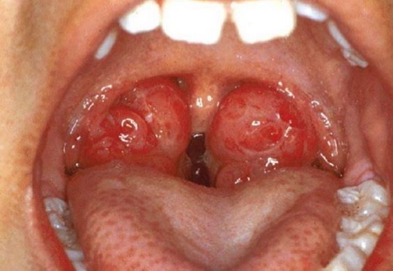 Irritation Of The Throat 16