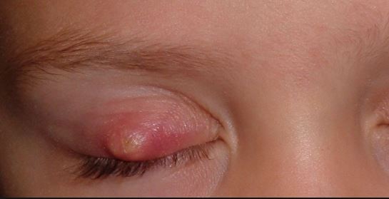Bump on nose, inside nose, small red, white painful bump on nose ... Stue skab