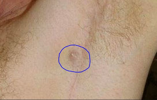 Lump Under Armpit Painful Hard Male Female Sore Small Red Swollen Tender Lump In Armpit Hurts