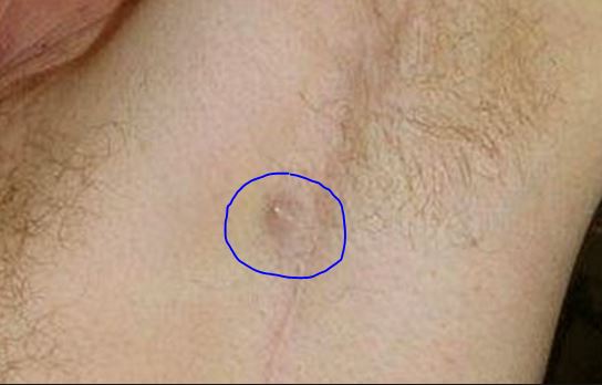 Lump Under Armpit Painful Hard Male Female Sore Small Red Swollen