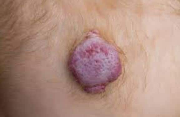 Tumor in armpit