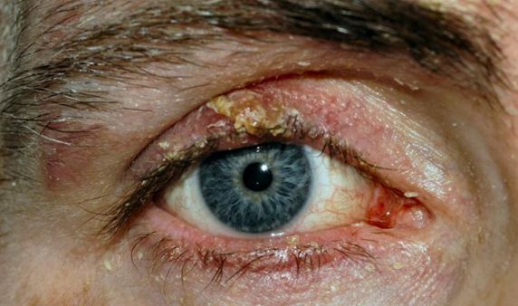 Ingrown eyelash on upper eyelid, removal, treatment, symptoms, bump ... Stue skab