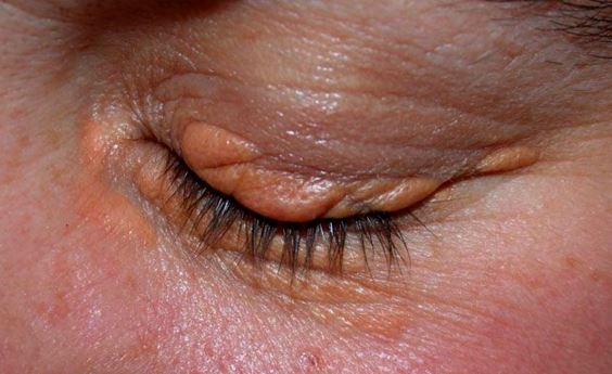 home remedy for stye inside the eyelid