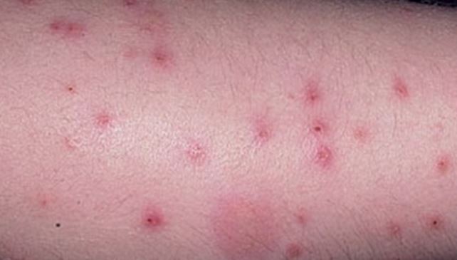4 Effective Home Remedies for Flea Bites Drscabies