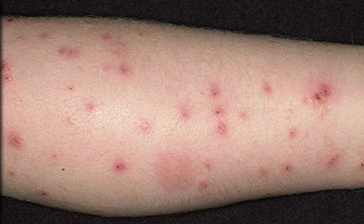 Flea bites vs. bed bug bites