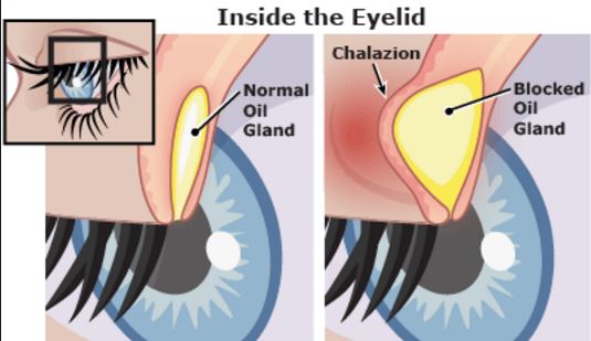 Pimple on Eyelid, Under, Inside, on Rim, Small White Lump, Upper Eyelid