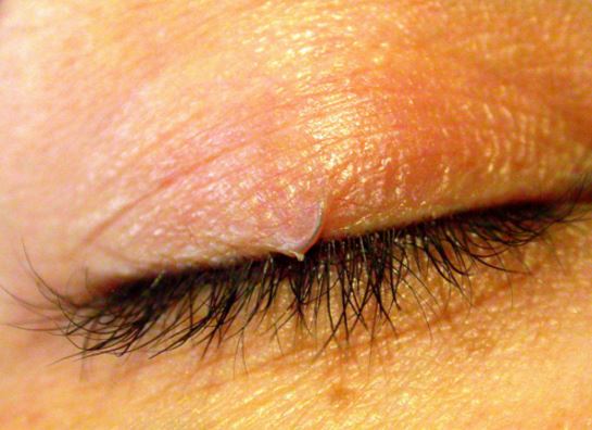 Ingrown eyelash on upper eyelid, removal, treatment, symptoms, bump ... Stue skab