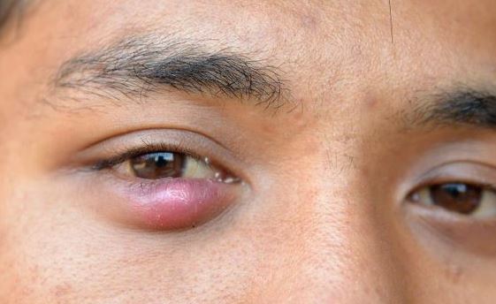 Pimple On Eyelid Under Inside On Rim Small White Lump Upper Eyelid 