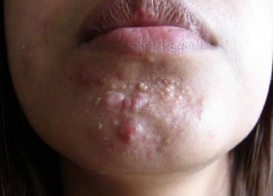 Stress, ovulation, pregnancy and PMS can cause chin breakouts