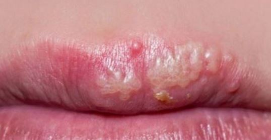 The blisters rapture and start to ooze