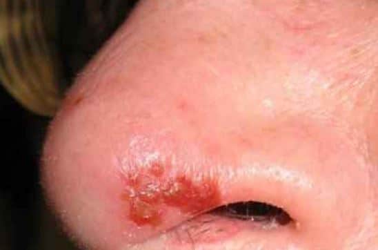 Sores in nose from allergy
