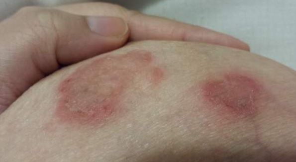 Pictures Of Rashes Between Your Breast 48