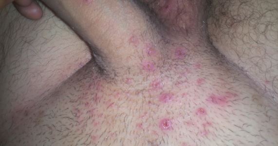 Red Bumps At Base Of Penis 107
