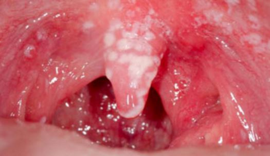 White Patches in Mouth Pictures, Small White Spots on Roof of Mouth Leukoplakia Bumps, Cancer