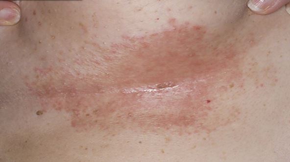 Pictures Of Rashes Between Your Breast 73