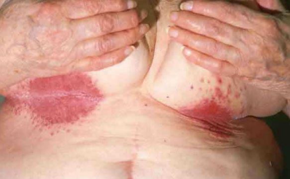 Sweat Rash On Penis 68