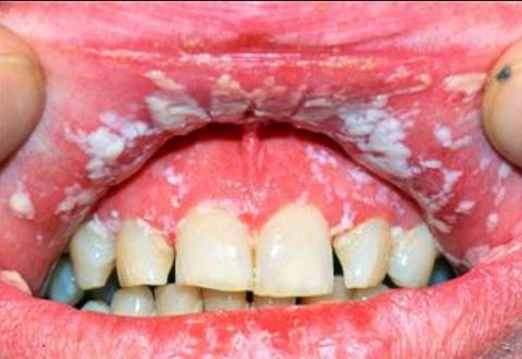 white stuff in dog's mouth