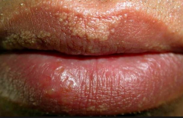 White Spots On Lips Herpes | Ownerlip.co