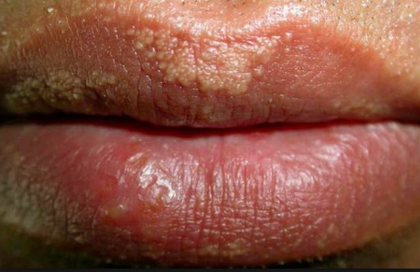 White Spots On Lips | www.pixshark.com - Images Galleries ...