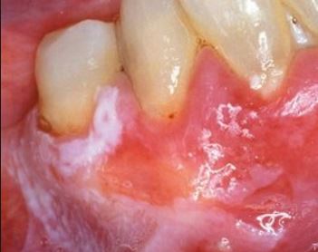 leukoplakia-white-patches-on-gums-due-to-smoking