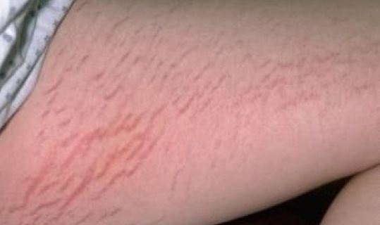 Stretch Marks on Legs, Calves of Teenager, Causes, Get Rid Of Stretch Marks Between Legs, Remove