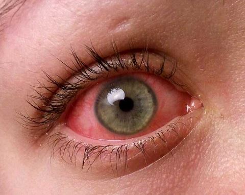 How To Get Rid Of The Pink Eye Naturally How To Get Rid Of The Pink Eye Naturally