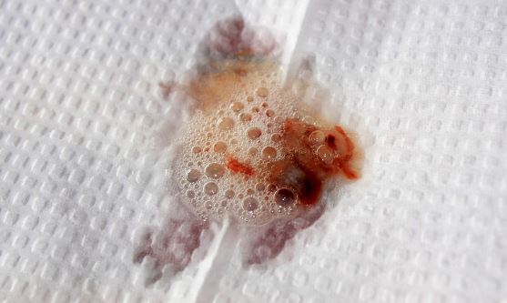 coughing up mucus coughing up brown mucus thick brown phlegm from lungs in the morning coughing up mucus coughing up brown mucus thick brown phlegm from lungs in the morning