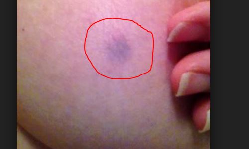 Quick Sex Jokes Purple Lump On Penis
