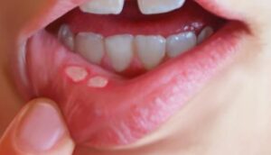 Pimple in Mouth, Around, Inside, Roof, Corner of Mouth, Get Rid of Small White, Red Mouth Pimple ...