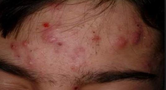nodular-acne-zits-on-forehead
