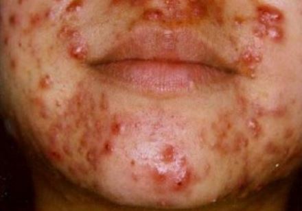 nodular acne