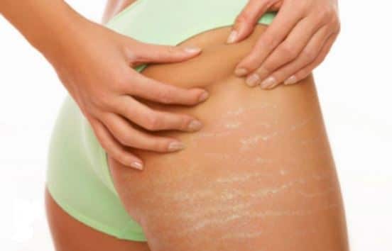 White stretch marks or silver stripes on thighs, buttocks and legs in teenagers