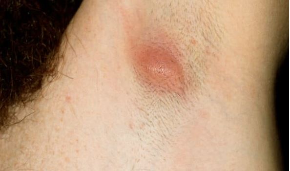 Armpit Cyst Pictures Painful Underarm Lump Causes Removal In Males
