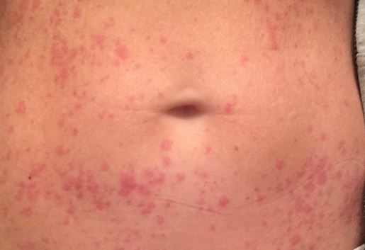 Rash On Stomach Itchy Red Heat Rash On Baby Std Lower Side Back