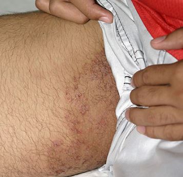 Fungal Rash On Penis 96