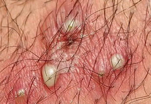 Apologise, blood filled pimples on my dick Opinion blood filled pimples on my dick question