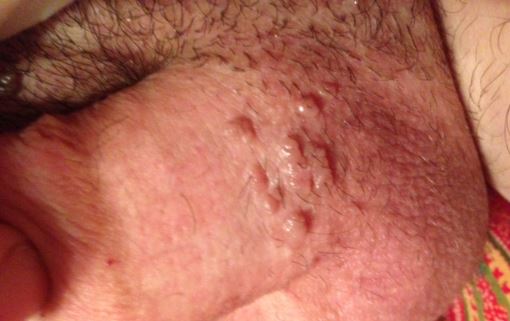 Ingrown Hair Cyst On Shaft
