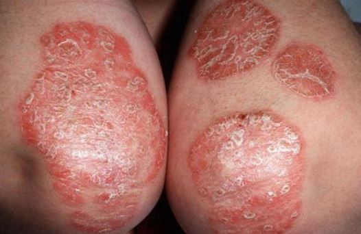 Contact dermatitis