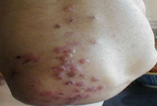 Itchy elbows due to rash and bumps on elbows