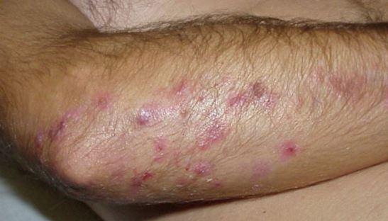 Itchy elbows due to rash and bumps on elbows