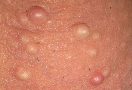 Small White Lumps On Penis 4