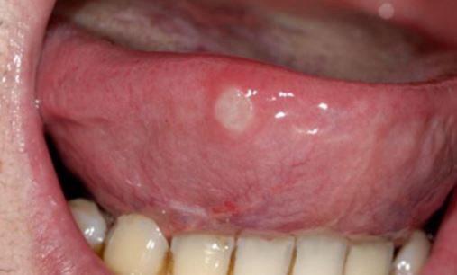 White Blister In Mouth