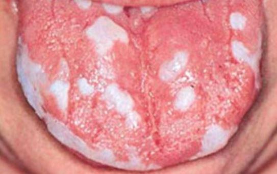 White Bumps on Tongue, Back, Under, Tip, Side, Small ...