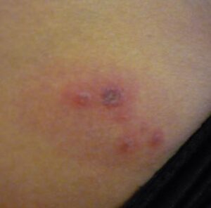 ingrown cyst